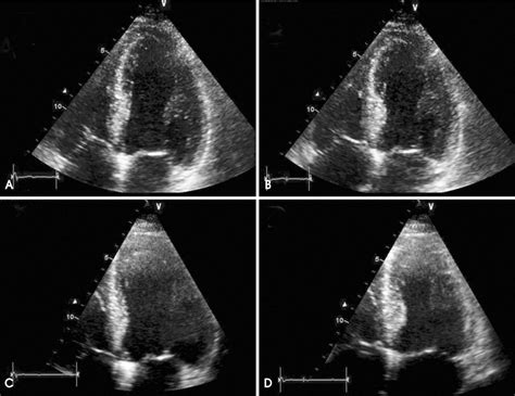 global hypokinesia in echo.